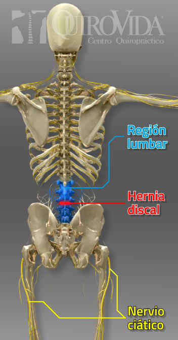 Hernia discal lumbar