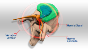 explicación de hernia discal